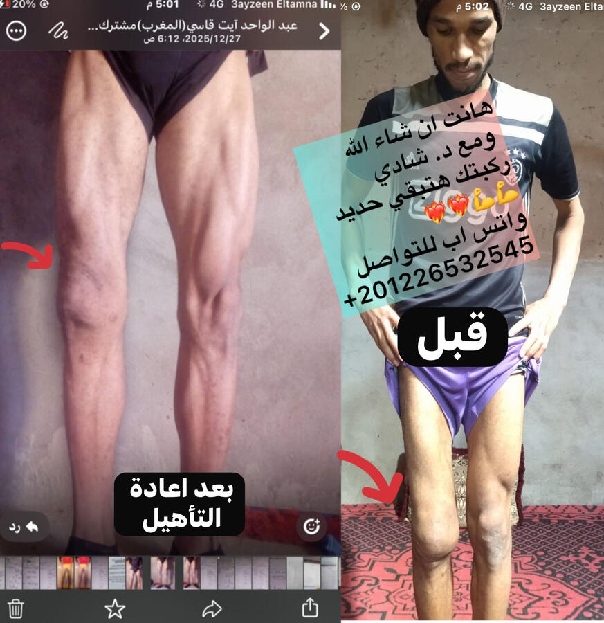نعالج التورم وضمور العضلات ومشكلات ما بعد جراحات الركبة والرباط الصليبي في اسرع وقت